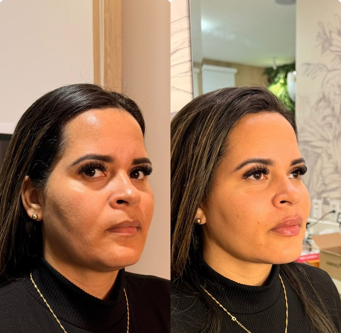 Bioreconexão, outra paciente