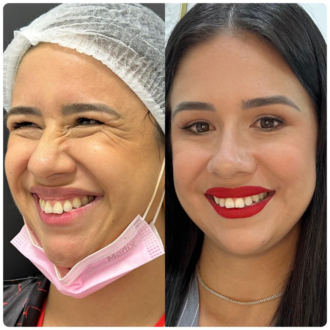 Toxina Botulínica, resultado 2