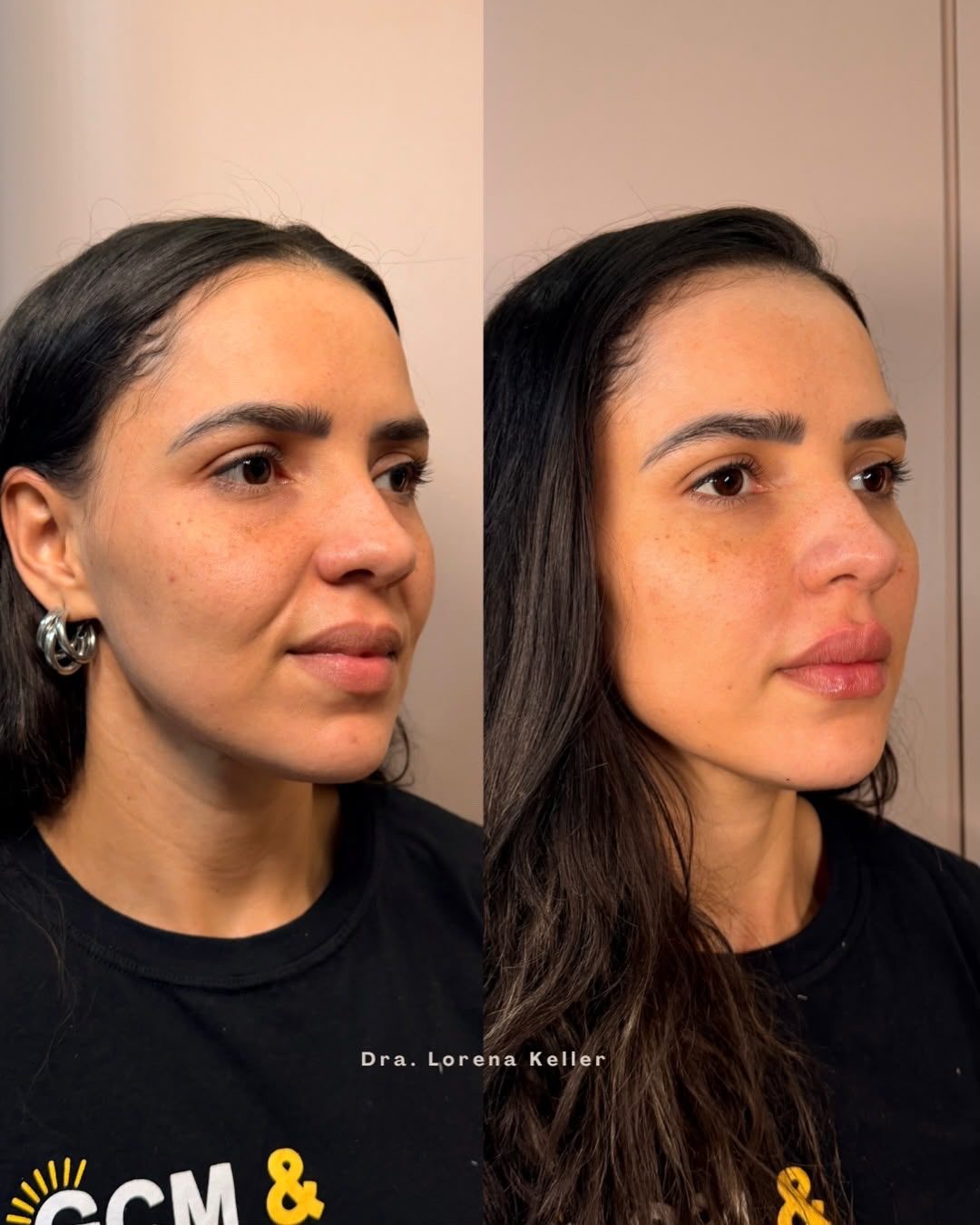 Harmonização Facial, perfil