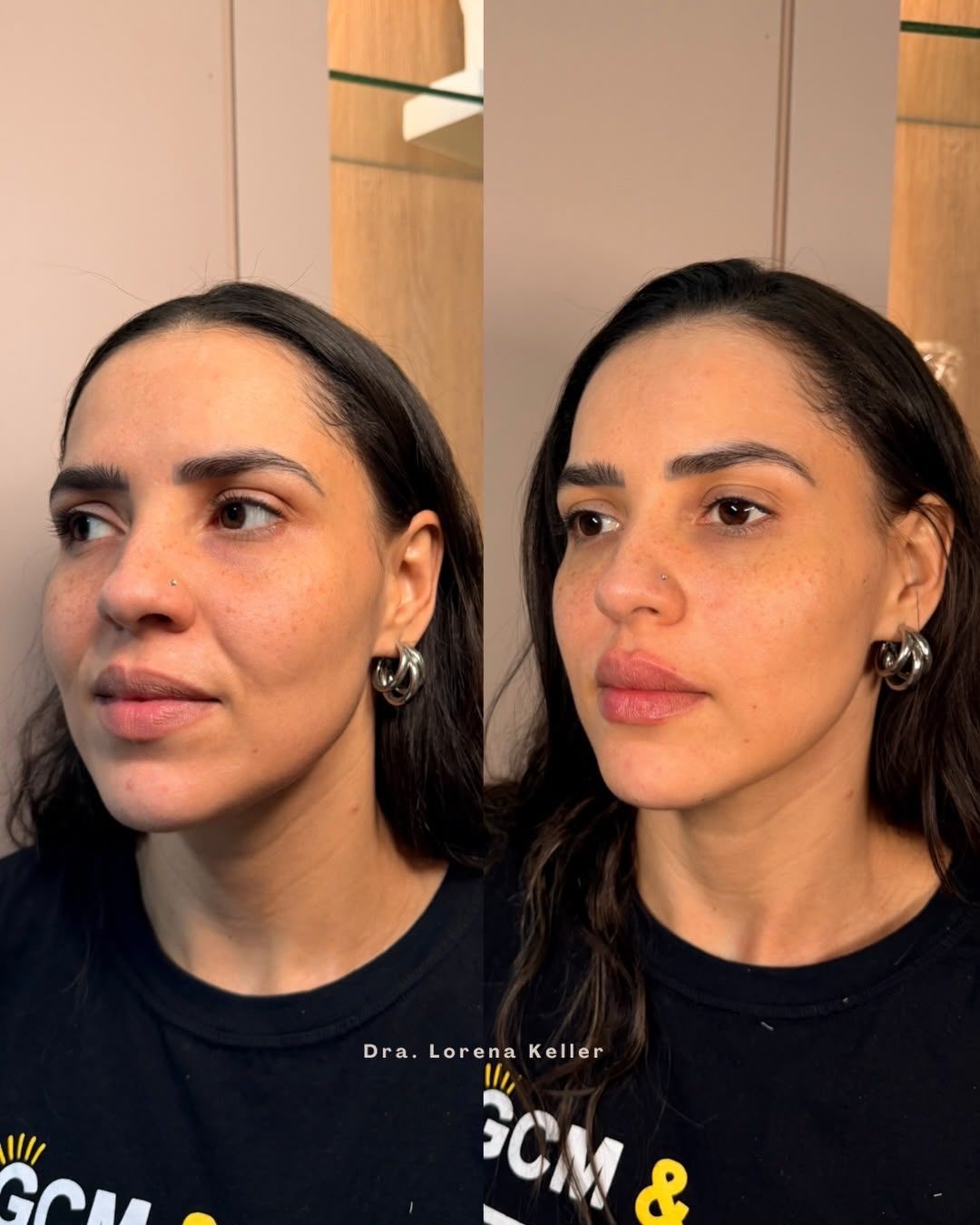 Harmonização Facial, ângulo 2
