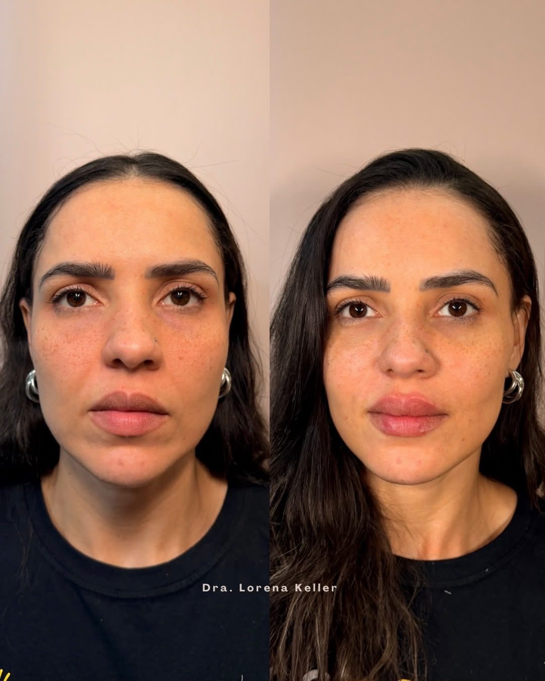 Harmonização Facial, frente